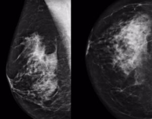 AI on breast screening