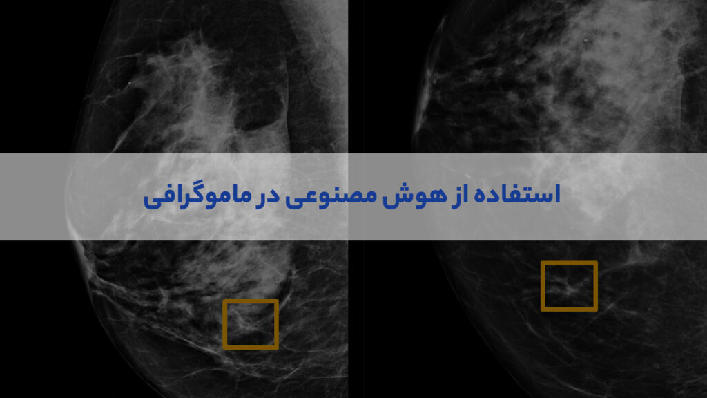 AI on mammogram